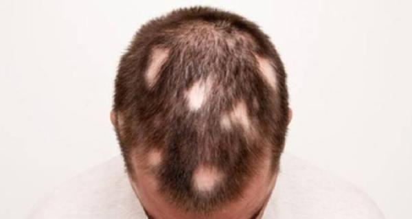 با چه روش هایی می توان ریزش مو سکه ای را درمان کرد؟