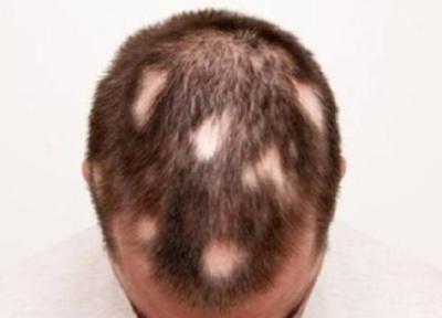 با چه روش هایی می توان ریزش مو سکه ای را درمان کرد؟